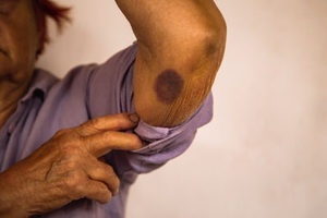 Advocacy for Elder Abuse: Facts, Myths, and Interventions